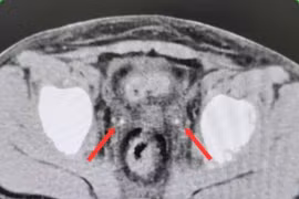 Kẹt sỏi niệu quản ở trẻ sau mổ viêm ruột thừa gây suy thận