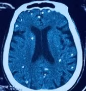 Rối loạn ý thức, suy hô hấp không ngờ nhiễm sán dây lợn