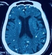 Rối loạn ý thức, suy hô hấp không ngờ nhiễm sán dây lợn