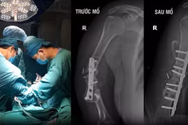 Lấy xương chậu ghép cứu cánh tay biến dạng do khớp giả