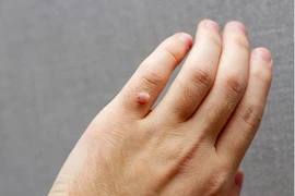 Mụn hạt cơm tưởng lành tính nhưng có thể gây nguy hiểm