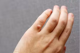 Mụn hạt cơm tưởng lành tính nhưng có thể gây nguy hiểm