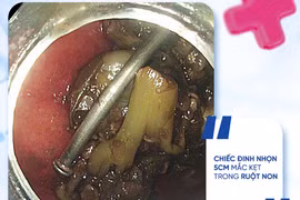 Chỉ một khoảnh khắc nghịch đồ, đinh 5 cm chui tọt vào ruột non trẻ 8 tuổi