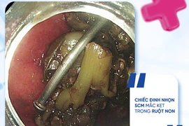 Chỉ một khoảnh khắc nghịch đồ, đinh 5 cm chui tọt vào ruột non trẻ 8 tuổi