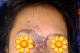 Bác sĩ chỉ rõ nhiều biến chứng chết người do tiêm filler làm đẹp