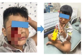Cấp cứu trẻ 5 tuổi bị chó cắn rách nát mặt phải
