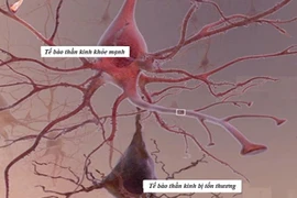 Biến chứng đa dây thần kinh ngoại biên do đái tháo đường có nguy hiểm?