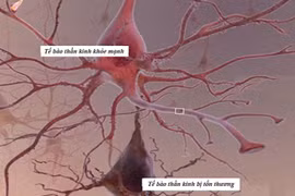 Biến chứng đa dây thần kinh ngoại biên do đái tháo đường có nguy hiểm?