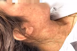 Người lớn chủ quan không tiêm phòng sởi bị biến chứng nặng