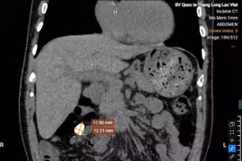 Uống nhầm thuốc sỏi thận nhiều năm, sự thật ngỡ ngàng khi chụp CT 'giải mã'