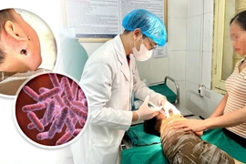 Bùn nước sau lũ lụt cẩn thận vi khuẩn ăn thịt người tấn công gây tử vong