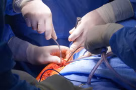 Thay khớp vai đảo nghịch nhân tạo cho cụ bà gãy nát khớp vai