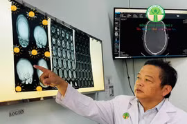 Tạo hình cho trẻ méo đầu do dính khớp sọ