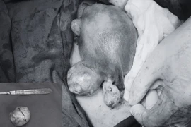 Sản phụ mang 3 khối u xơ tử cung vượt cạn an toàn nhờ phẫu thuật kịp thời