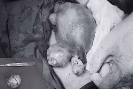 Sản phụ mang 3 khối u xơ tử cung vượt cạn an toàn nhờ phẫu thuật kịp thời