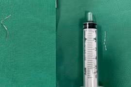 Trẻ 1 tuổi hóc dị vật dây kim loại 3 cm khi ăn cháo