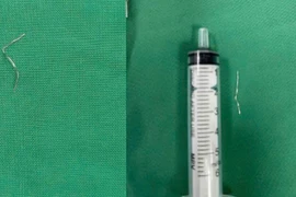 Trẻ 1 tuổi hóc dị vật dây kim loại 3 cm khi ăn cháo
