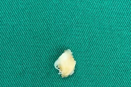 Đau, hạn chế vận động khớp cổ chân không ngờ xương mắc kẹt trong khớp