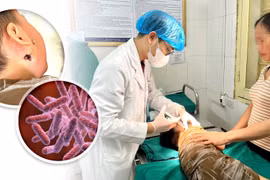 Đau mang tai, sốt cao trẻ 4 tuổi nguy kịch vì vi khuẩn ăn thịt người