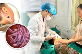 Đau mang tai, sốt cao trẻ 4 tuổi nguy kịch vì vi khuẩn ăn thịt người