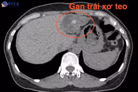 Đau bụng tái diễn không ngờ sỏi lấp đầy ống mật chủ, gan