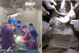 Ngã từ độ cao 4m vào thanh sắt khi dọn nhà đón tết, người bệnh nguy kịch