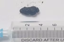 Sỏi ống mật chủ tái phát cẩn thận sốc nhiễm trùng đe dọa tính mạng