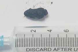 Sỏi ống mật chủ tái phát cẩn thận sốc nhiễm trùng đe dọa tính mạng