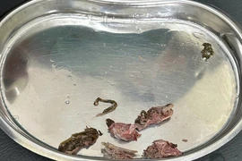 Nội soi gắp thành công 4 mảnh xương mắc trong thực quản người đàn ông