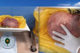 U xơ tử cung nặng 3,5 kg gây thiếu máu nặng, chèn ép niệu quản 2 bên