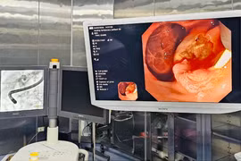 Lấy thành công sỏi gây tắc ống mật chủ cho cụ ông 89 tuổi