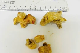 Phẫu thuật thành công lấy sỏi thận, sỏi san hô cho người bệnh