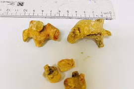 Phẫu thuật thành công lấy sỏi thận, sỏi san hô cho người bệnh