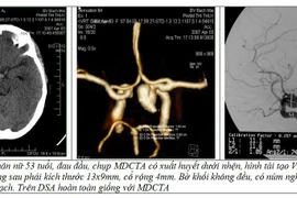 Kiểu đau đầu sét đánh nguy cơ tử vong cao 40-50%