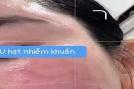 Người phụ nữ mọc u hạt, phù nề toàn bộ mặt sau 2 ngày tiêm meso