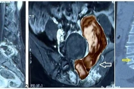 Đau lưng người phụ nữ 48 tuổi không ngờ u cột sống quái ác quay lại