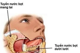 Chọn đúng u tuyến nước bọt cần phẫu thuật nhờ FNA tuyến nước bọt
