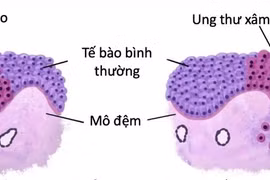 Phát hiện loạn sản độ cao:- cơ hội chặn đứng ung thư từ sớm