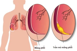 Viêm mủ màng phổi nguy hiểm, đe dọa tính mạng