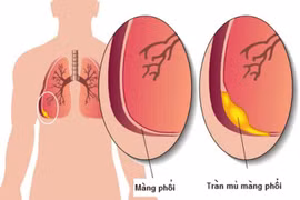 Viêm mủ màng phổi nguy hiểm, đe dọa tính mạng