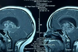 Phẫu thuật khẩn cấp cứu chàng trai 21 tuổi hôn mê sâu do u sọ hầu tái phát