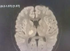 Bất ngờ trẻ 13 tuổi đang khỏe mạnh thì đột quỵ