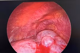 Cứu sống trẻ 13 tuổi nguy cấp vì vỡ kén khi gây tràn khí màng phổi