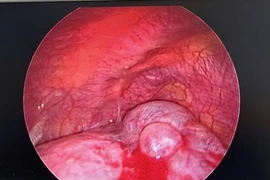 Cứu sống trẻ 13 tuổi nguy cấp vì vỡ kén khi gây tràn khí màng phổi