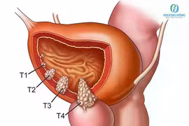 Mỗi năm 1000 người tử vong vì ung thư bàng quang, cách gì phòng tránh?
