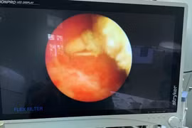 Vòng tránh thai 10 năm lạc chỗ vào bàng quang tạo sỏi