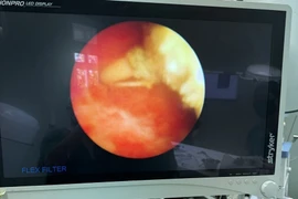 Vòng tránh thai 10 năm lạc chỗ vào bàng quang tạo sỏi