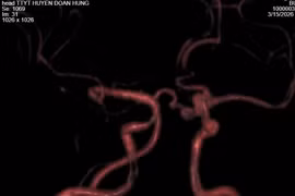 Chủ quan đau đầu có thể vỡ túi phình mạch máu não đe dọa tính mạng