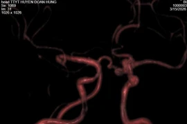 Chủ quan đau đầu có thể vỡ túi phình mạch máu não đe dọa tính mạng