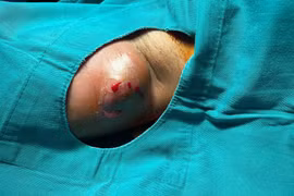 Cẩn thận áp xe mô mềm biến chứng đe dọa tính mạng